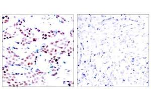 Immunohistochemical analysis of paraffin-embedded human breast carcinoma tissue using c-Jun (phospho-Thr91) antibody (E011021). (C-JUN 抗体  (pThr91))