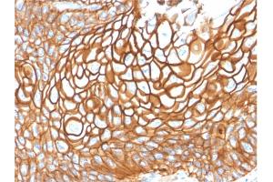 Formalin-fixed, paraffin-embedded human Basal Cell Carcinoma stained with CD9 Mouse Monoclonal Antibody (CD9/1619). (CD9 抗体)