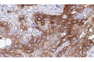 ABIN6273988 at 1/100 staining Human Head and neck cancer tissue by IHC-P. (RGR 抗体  (Internal Region))