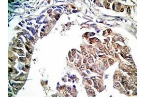 Human stomach cancer tissue was stained by rabbit Anti-Spexin prepro (36-58)  (H) Antibody (Spexin 抗体  (Preproprotein))