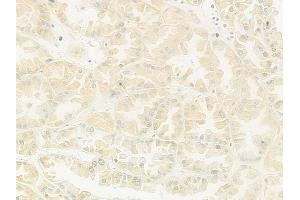 ABIN6266145 and ABIN6272952 at 1/100 staining human renal cell carcinoma by IHC-P.