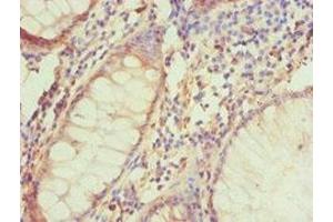Immunohistochemistry of paraffin-embedded human colon cancer using ABIN7145332 at dilution of 1:100 (BNIP3L/NIX 抗体  (AA 1-187))