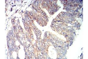 Immunohistochemical analysis of paraffin-embedded rectum cancer tissues using CD166 mouse mAb with DAB staining. (CD166 抗体  (AA 227-381))
