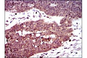 Immunohistochemical analysis of paraffin-embedded ovarian cancer tissues using DCTN4 mouse mAb with DAB staining. (Dynactin 4 抗体  (AA 57-298))