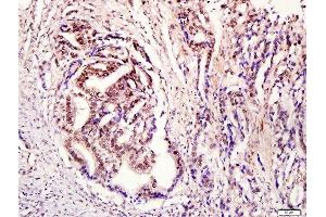 Paraformaldehyde-fixed, paraffin embedded human stomach cancer tissue, Antigen retrieval by boiling in sodium citrate buffer(pH6) for 15min, Block endogenous peroxidase by 3% hydrogen peroxide for 30 minutes, Blocking buffer (normal goat serum) at 37°C for 20min, Antibody incubation with Rabbit Anti-STAT3 (Tyr705) Polyclonal Antibody, Unconjugated  at 1:400 overnight at 4°C, followed by a conjugated secondary and DAB staining (STAT3 抗体  (pTyr705))