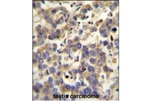 LYPD4 antibody (Center) (ABIN654302 and ABIN2844090) immunohistochemistry analysis in formalin fixed and paraffin embedded human testis carcinoma followed by peroxidase conjugation of the secondary antibody and DAB staining. (LYPD4 抗体  (AA 104-133))