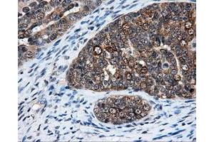 Immunohistochemical staining of paraffin-embedded Adenocarcinoma of breast tissue using anti-ELAVL1 mouse monoclonal antibody. (ELAVL1 抗体)