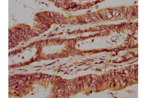 IHC image of ABIN7153701 diluted at 1:300 and staining in paraffin-embedded human colon cancer performed on a Leica BondTM system. (Mare/Nprl3/C16orf35 抗体  (AA 349-482))