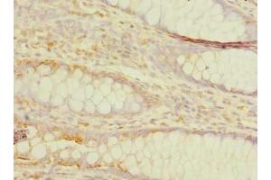 Immunohistochemistry of paraffin-embedded human colon cancer using ABIN7173249 at dilution of 1:100 (TMEM59L 抗体  (AA 27-267))