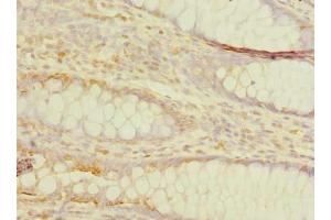 Immunohistochemistry of paraffin-embedded human colon cancer using ABIN7173249 at dilution of 1:100 (TMEM59L 抗体  (AA 27-267))
