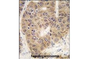 Immunohistochemistry (Paraffin-embedded Sections) (IHC (p)) image for anti-Small Ubiquitin Related Modifier 4 (SUMO4) (Mutant), (Val55) antibody (ABIN388079)