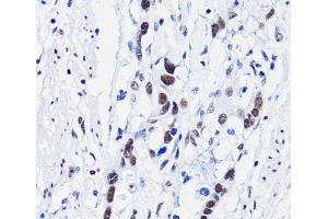 Immunohistochemistry of paraffin-embedded Human gastric cancer using Acetyl-Histone H4-K8 Polyclonal Antibody at dilution of 1:100 (40x lens).