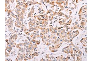 The image on the left is immunohistochemistry of paraffin-embedded Human breast cancer tissue using ABIN7189654(ADAMTS16 Antibody) at dilution 1/50, on the right is treated with synthetic peptide. (ADAMTS16 抗体)