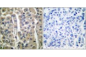 Immunohistochemistry analysis of paraffin-embedded human breast carcinoma tissue, using Involucrin Antibody. (Involucrin 抗体  (AA 536-585))