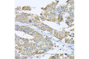 Immunohistochemistry of paraffin-embedded human liver cancer using COQ7 antibody at dilution of 1:100 (x40 lens). (Coq7 抗体)