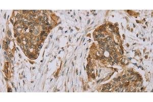 Immunohistochemistry of paraffin-embedded Human esophagus cancer using MVK Polyclonal Antibody at dilution of 1:40 (MVK 抗体)