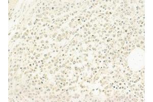 ABIN6263911 and ABIN6278220 at 1/100 staining human Hodgkin lymphoma by IHC-P. (OSR1 抗体  (C-Term))