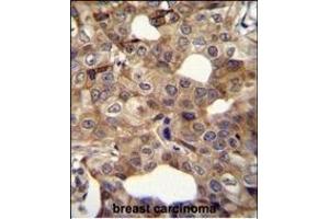 CCNI2 Antibody (Center) (ABIN655840 and ABIN2845254) immunohistochemistry analysis in formalin fixed and paraffin embedded human breast carcinoma followed by peroxidase conjugation of the secondary antibody and DAB staining. (CCNI2 抗体  (AA 92-121))