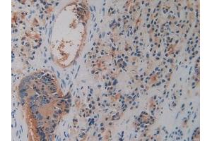 Detection of CD26 in Human Prostate cancer Tissue using Polyclonal Antibody to Cluster Of Differentiation 26 (CD26)