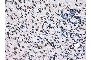 Immunohistochemical staining of paraffin-embedded Adenocarcinoma of breast tissue using anti-TTLL12 mouse monoclonal antibody. (TTLL12 抗体)