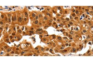 Immunohistochemistry of paraffin-embedded Human lung cancer using 14-3-3 beta/alpha Polyclonal Antibody at dilution of 1:30 (YWHAB 抗体)