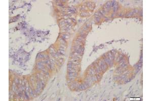 Formalin-fixed and paraffin embedded human cervical cancer labeled with Rabbit Anti-HSD17B1 Polyclonal Antibody, Unconjugated  at 1:200 followed by conjugation to the secondary antibody and DAB staining (HSD17B1 抗体  (AA 21-120))