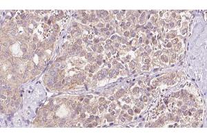 ABIN6273307 at 1/100 staining Human thyroid cancer tissue by IHC-P. (REEP2 抗体  (Internal Region))