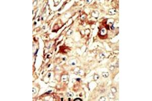 Formalin-fixed and paraffin-embedded human cancer tissue reacted with the primary antibody, which was peroxidase-conjugated to the secondary antibody, followed by AEC staining. (WEE1 抗体  (AA 144-173))