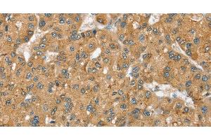Immunohistochemistry of paraffin-embedded Human liver cancer using SEC14L2 Polyclonal Antibody at dilution of 1:40 (SEC14L2 抗体)