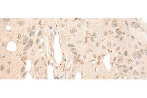 Immunohistochemistry of paraffin-embedded Human esophagus cancer tissue using DDX21 Polyclonal Antibody at dilution of 1:40(x200) (DDX21 抗体)