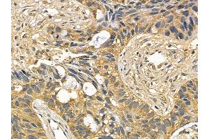 PIKFYVE Mouse Monoclonal Antibody at 1/100 staining human lung cancer and adjacent non-tumor tissue by IHC-P. (PIKFYVE 抗体)