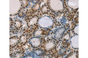 Immunohistochemistry of Human thyroid cancer using RUNX1T1 Polyclonal Antibody at dilution of 1:35 (RUNX1T1 抗体)