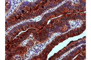 Immunohistochemistry staining of human colon adenocarcinoma (paraffin-embedded sections) with anti-Blood Group Lewis a (7LE). (Blood Group Lewis A 抗体)