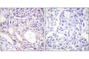 Immunohistochemistry analysis of paraffin-embedded human breast carcinoma, using Aurora Kinase (Phospho-Thr288) Antibody. (Aurora Kinase (AA 256-305), (pThr288) 抗体)