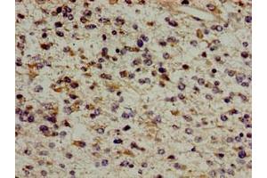 Immunohistochemistry of paraffin-embedded human glioma using ABIN7154609 at dilution of 1:100 (ERAL1 抗体  (AA 271-382))