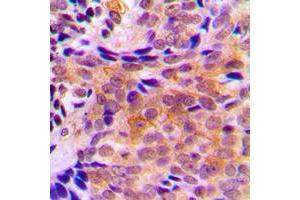 Immunohistochemical analysis of ACOT2 staining in human breast cancer formalin fixed paraffin embedded tissue section. (ACOT2 抗体  (Center))