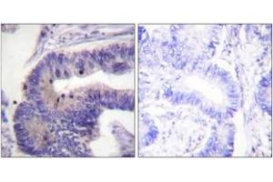 Immunohistochemistry analysis of paraffin-embedded human colon carcinoma tissue, using PDE4D (Ab-190/53) Antibody. (PDE4D 抗体  (AA 156-205))