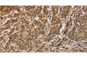Immunohistochemistry of paraffin-embedded Human gastric cancer using CALU Polyclonal Antibody at dilution of 1:40 (CALU 抗体)