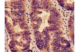 Immunohistochemistry analysis of human colon cancer using ABIN7151715 at dilution of 1:100 (ybeY 抗体  (AA 54-167))