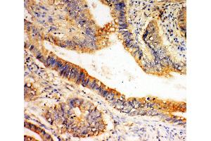 Anti-SLC1A4 antibody, IHC(P) IHC(P): Human Intestinal Cancer Tissue (SLC1A4 抗体  (C-Term))
