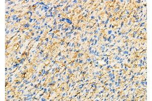 ABIN6259837 and ABIN6276791 at 1/100 staining Human ovarian cancer and adjacent normal tissues by IHC-P.