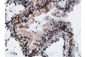 Immunohistochemical staining of paraffin-embedded Adenocarcinoma of Human breast tissue using anti-EPM2AIP1 mouse monoclonal antibody. (EPM2AIP1 抗体)