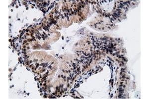 Immunohistochemical staining of paraffin-embedded Adenocarcinoma of Human breast tissue using anti-EPM2AIP1 mouse monoclonal antibody.