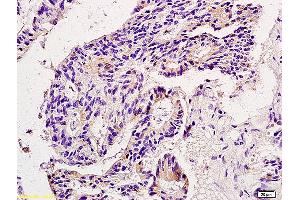 Formalin-fixed and paraffin embedded human colon carcinoma labeled with Anti-MMP9 Polyclonal Antibody, Unconjugated (ABIN873171) at 1:200 followed by conjugation to the secondary antibody and DAB staining. (MMP 9 抗体  (AA 151-250))