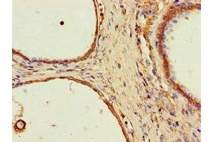 Immunohistochemistry of paraffin-embedded human prostate cancer using ABIN7169623 at dilution of 1:100 (SPPL2A 抗体  (AA 26-172))