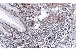 IHC-P Image Immunohistochemical analysis of paraffin-embedded human gastric cancer, using DDX39, antibody at 1:100 dilution. (BAT1 抗体  (Center))