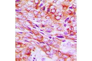Immunohistochemical analysis of TMBIM1 staining in human breast cancer formalin fixed paraffin embedded tissue section. (TMBIM1 抗体  (C-Term))
