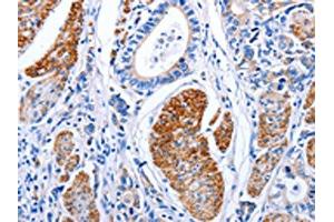 The image on the left is immunohistochemistry of paraffin-embedded Human stomach cancer tissue using ABIN7191274(LIF Antibody) at dilution 1/25, on the right is treated with synthetic peptide. (LIF 抗体)