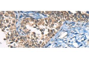 Immunohistochemistry of paraffin-embedded Human ovarian cancer tissue using CDKL4 Polyclonal Antibody at dilution of 1:45(x200) (CDKL4 抗体)