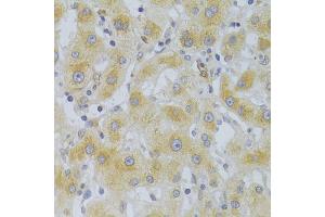 Immunohistochemistry of paraffin-embedded human liver cancer using EIF4G1 Antibody (ABIN5975844) at dilution of 1/100 (40x lens). (EIF4G1 抗体)